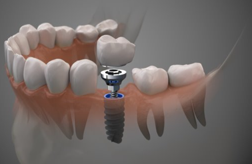 Implantes dentário